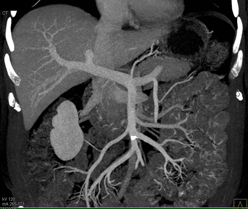 CTA with Increased Enhancement of the Small Bowel - CTisus CT Scan