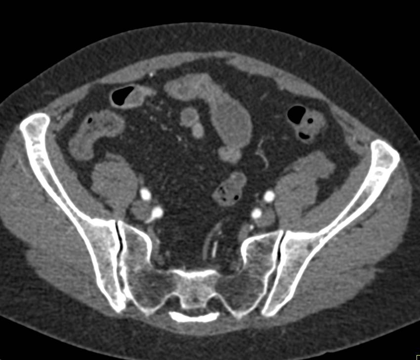 Crohn's Disease with Small Bowel Stricture - CTisus CT Scan