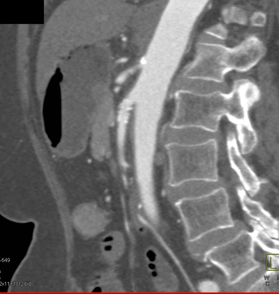 Patent Stent in the SMA - CTisus CT Scan