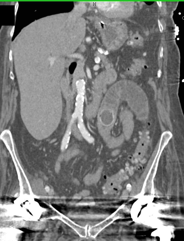 Small Bowel Leiomyoma - CTisus CT Scan