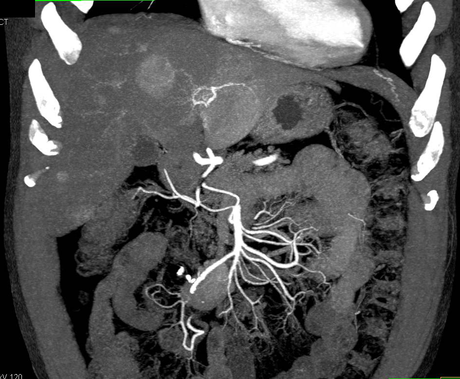 Carcinoid Tumor Root of Mesentery with Liver Metastases - CTisus CT Scan