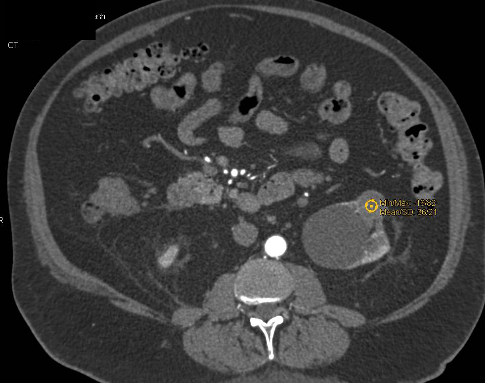 Carcinoid Tumor Encases the Superior Mesenteric Artery (SMA) Branches with Desmoplastic Reaction - CTisus CT Scan