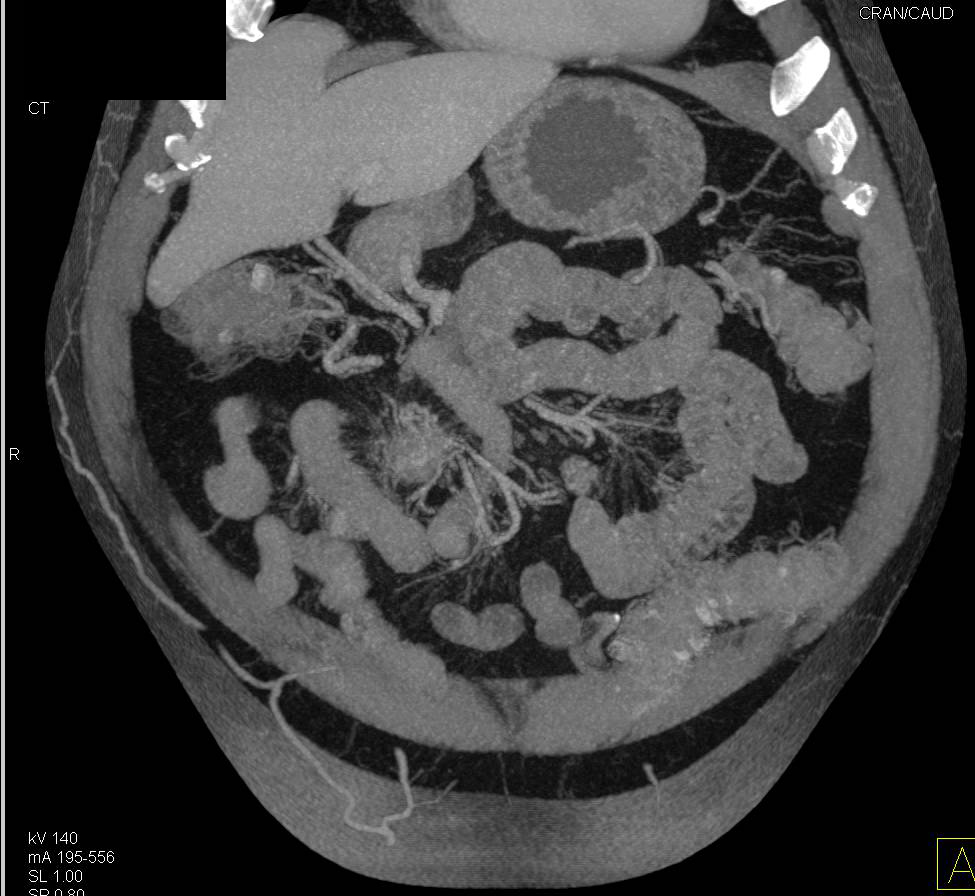 Small Bowel Carcinoid Tumor in RLQ With Desmoplastic Reaction - CTisus CT Scan