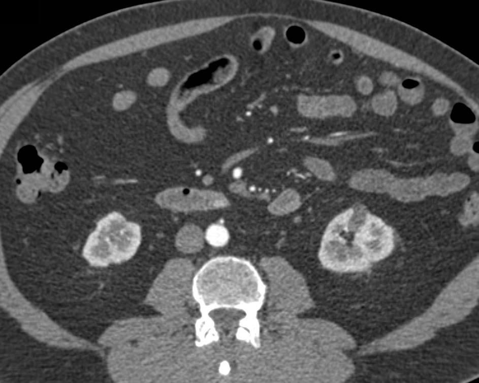 1 cm Carcinoid Tumor in the 3rd Portion of the Duodenum - CTisus CT Scan