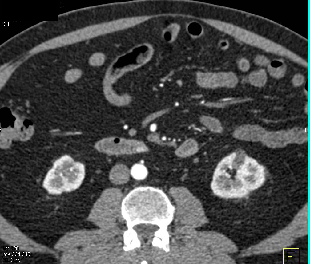 1cm Carcinoid Tumor in Duodenum - CTisus CT Scan