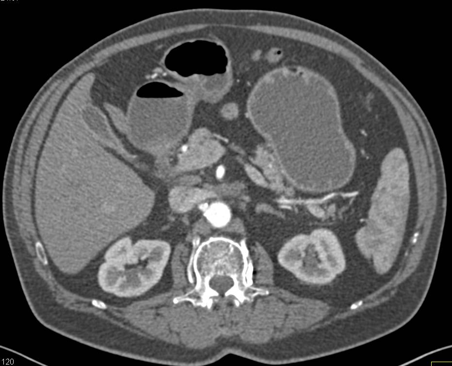 Adenocarcinoma of Duodenum - CTisus CT Scan