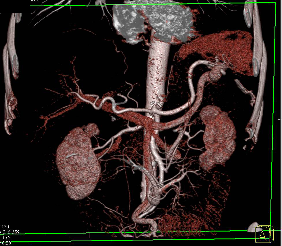 CTA with Normal Mesenteric Arcade - CTisus CT Scan