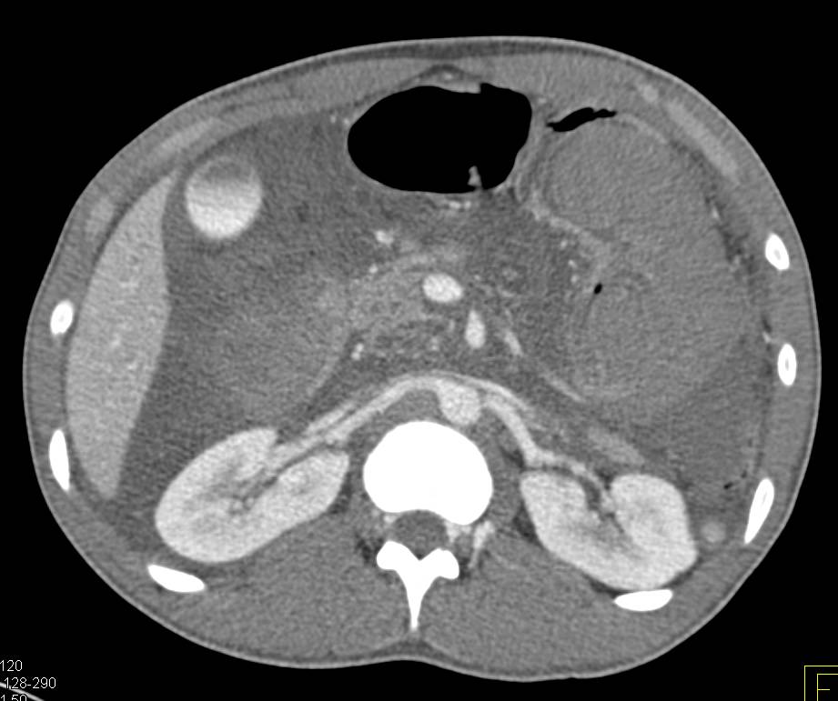 Extensive Duodenal Hematoma due to Coumadin - CTisus CT Scan