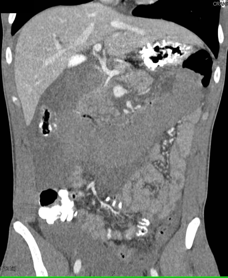 Large Duodenal Hematoma - CTisus CT Scan