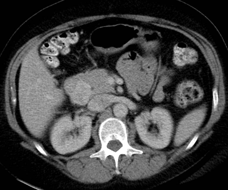 GIST tumor Duodenum Simulates a Pancreatic Mass - CTisus CT Scan