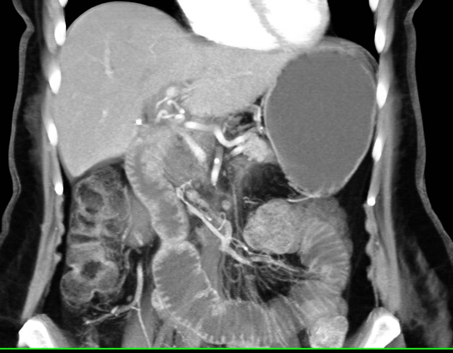 Recurrent Small Bowel Adenocarcinoma Results in Small Bowel Obstruction (SBO) - CTisus CT Scan