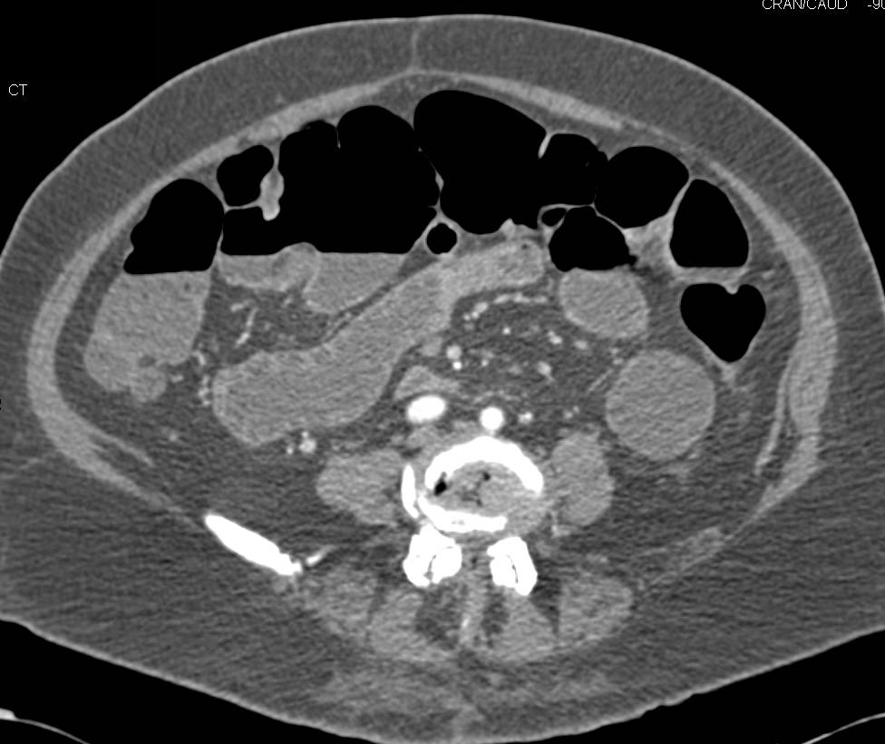 Small Bowel Obstruction (SBO) due to Small Bowel Adenocarcinoma - CTisus CT Scan