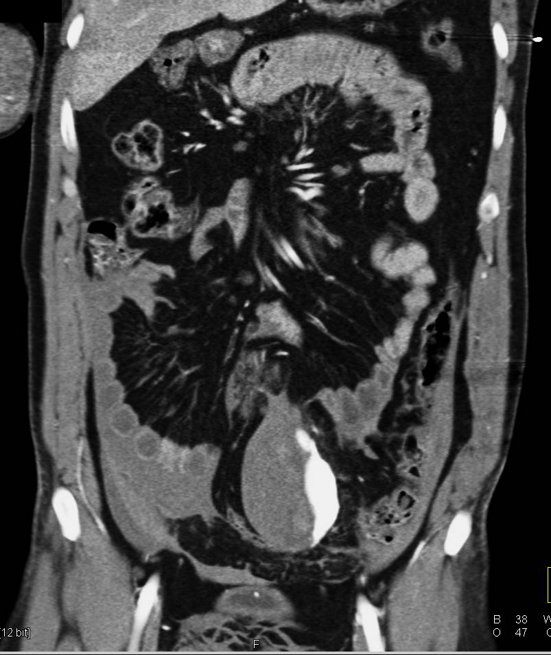 Bleeding Pseudoaneurysm with Hemoperitoneum - CTisus CT Scan