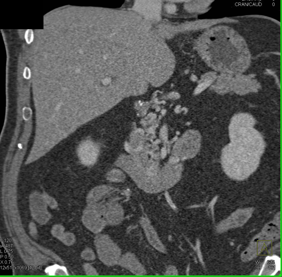 Carcinoid Tumor Root of Mesentery Involves the Superior Mesenteric Vein (SMV) and Superior Mesenteric Artery (SMA) - CTisus CT Scan