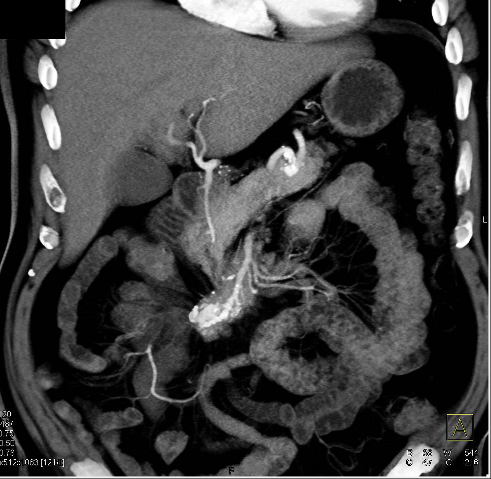 Carcinoid in the root of the Mesentery - CTisus CT Scan