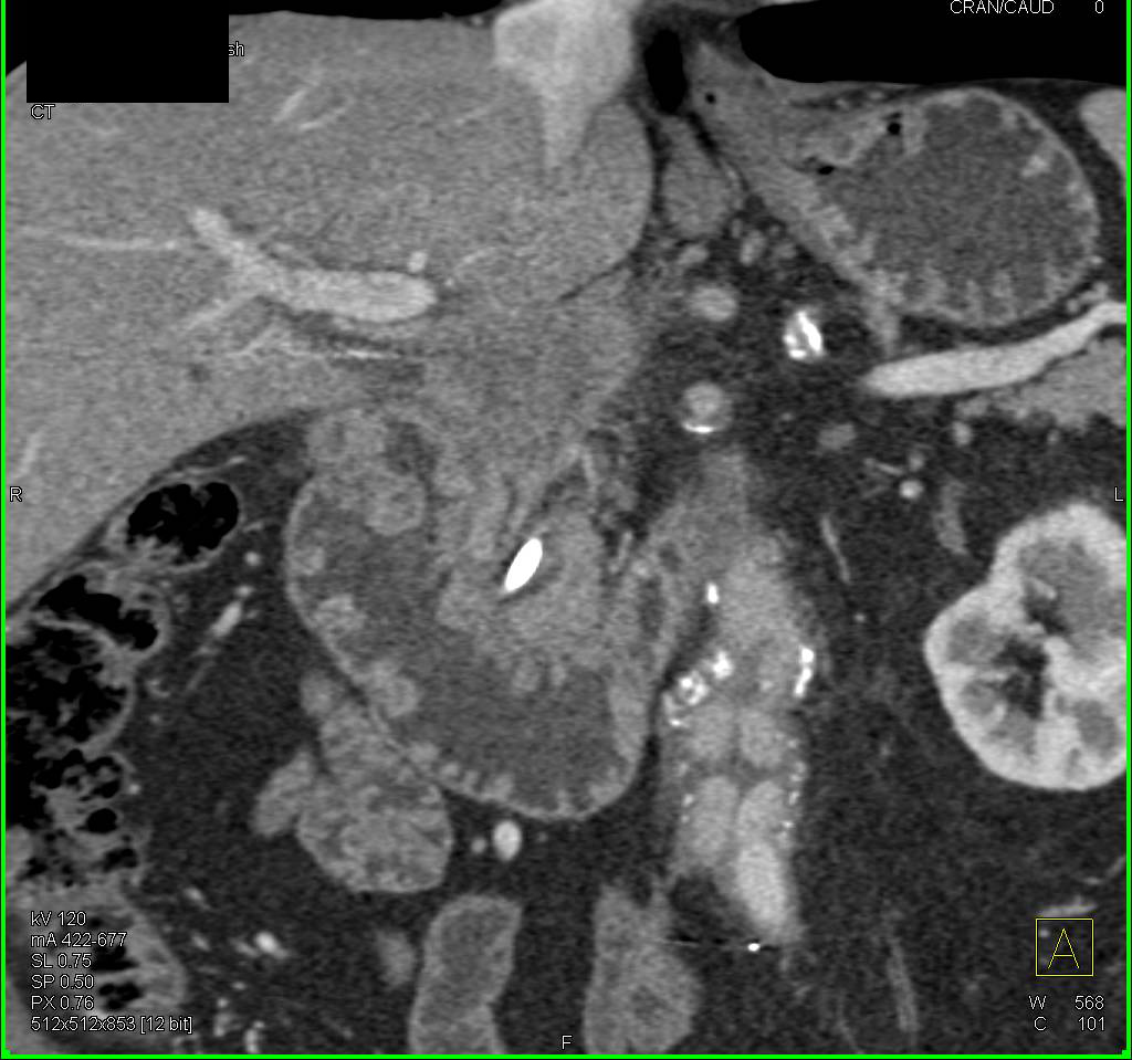 Multiple Duodenal Polyps - CTisus CT Scan