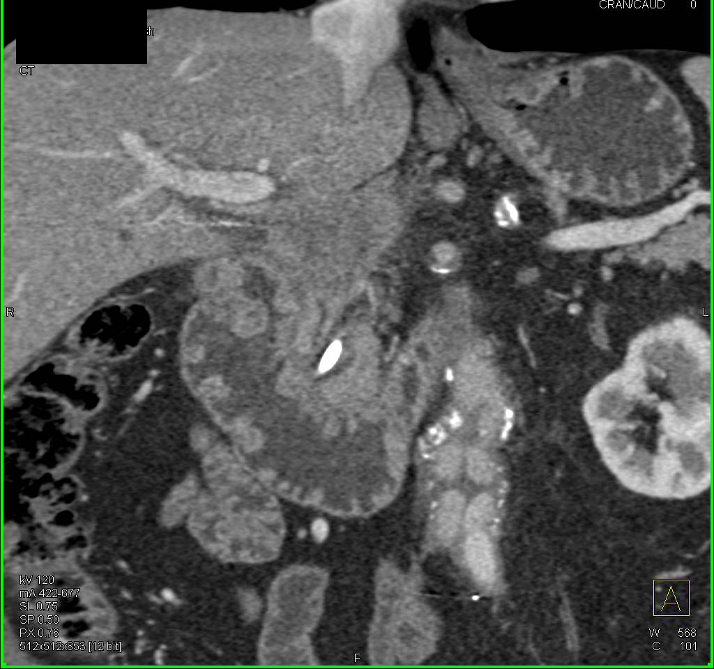 Duodenal Polyps in a Patient with Familial Polyposis - CTisus CT Scan