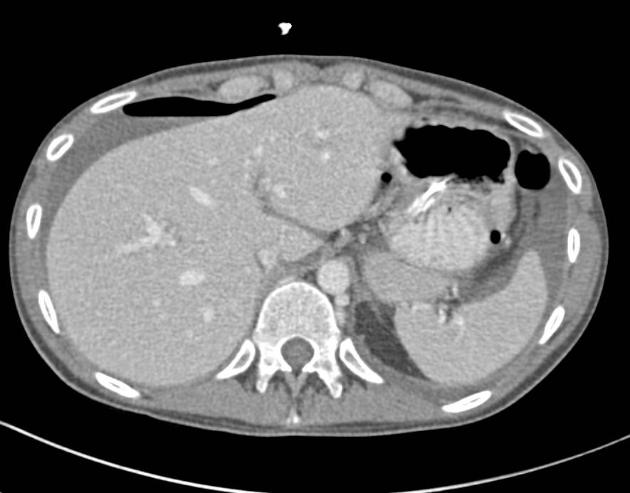Dilated Small Bowel s/p Iliostomy with Pneumoperitoneum - CTisus CT Scan