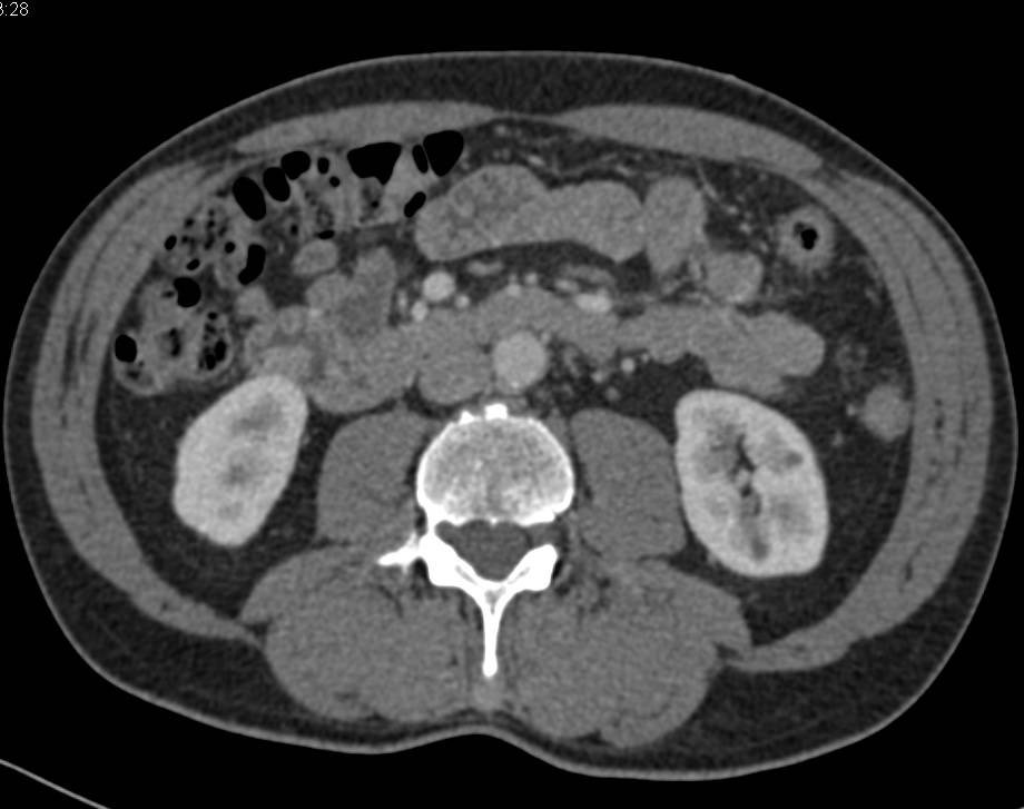 Duodenal Carcinoma - CTisus CT Scan