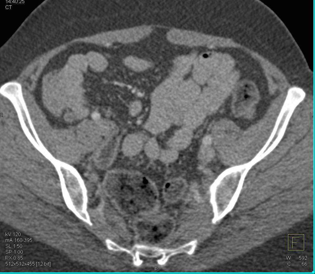 Normal Small Bowel with Neutral Contrast - CTisus CT Scan