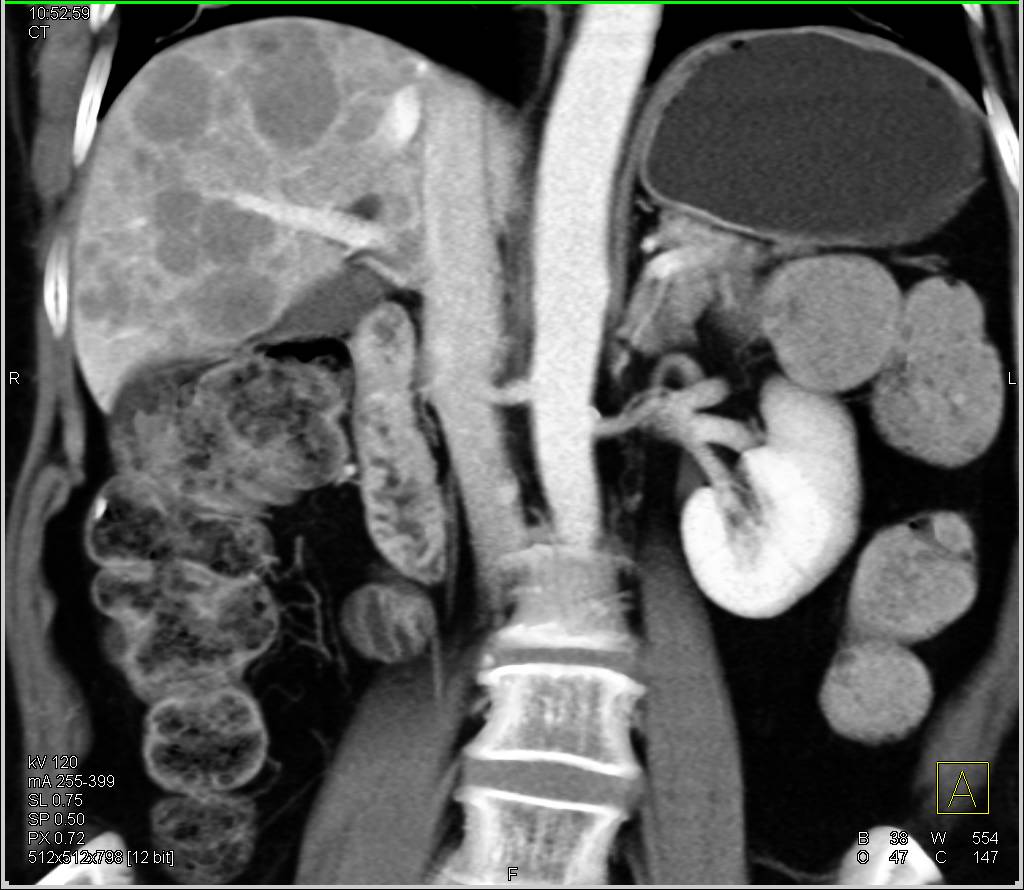 Carcinoid Tumor with Enhancement in the Primary Tumor and Liver Metastases - CTisus CT Scan