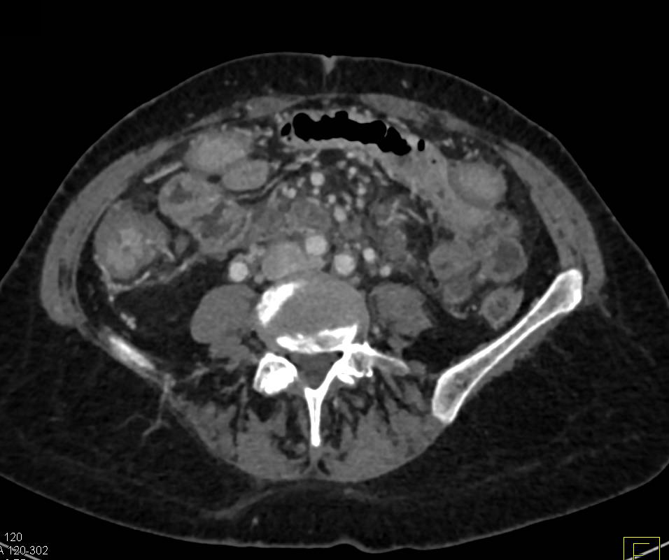 Thickened Small Bowel due to Desmoplastic Rxn - CTisus CT Scan