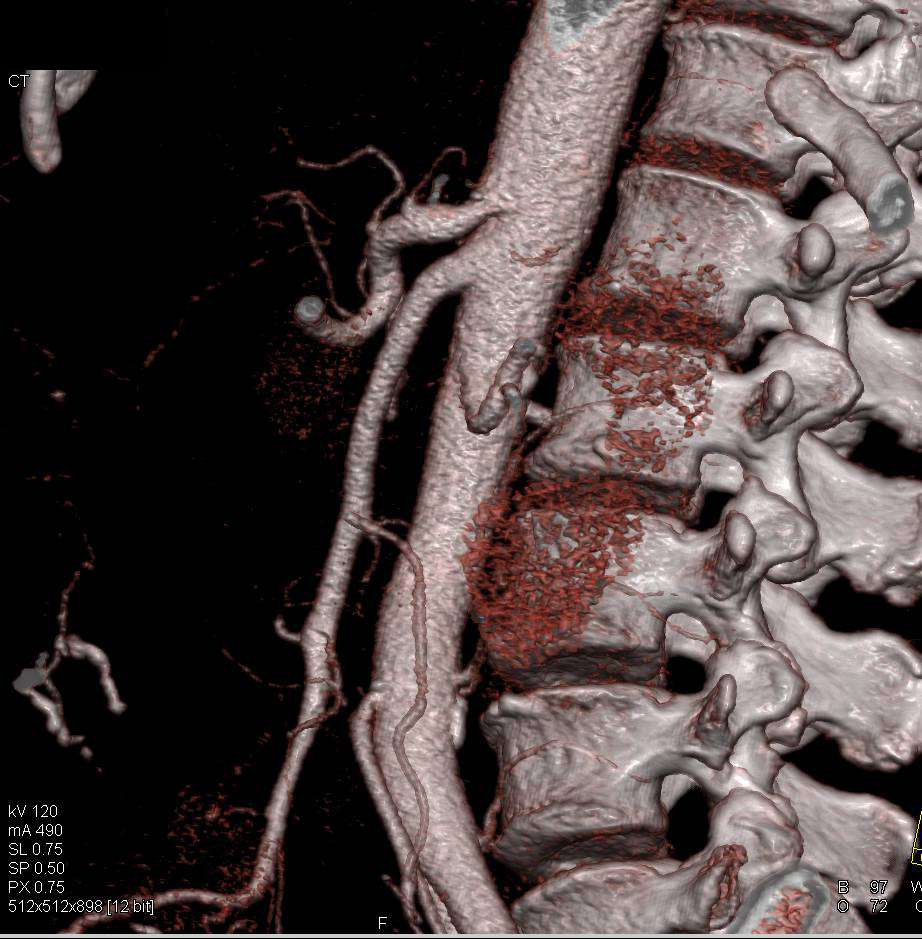 Carcinoid Tumor in the Root of the Mesentery - CTisus CT Scan