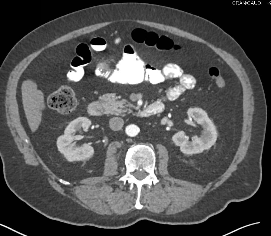 Small Bowel Adenocarcinoma at Transition Zone - CTisus CT Scan