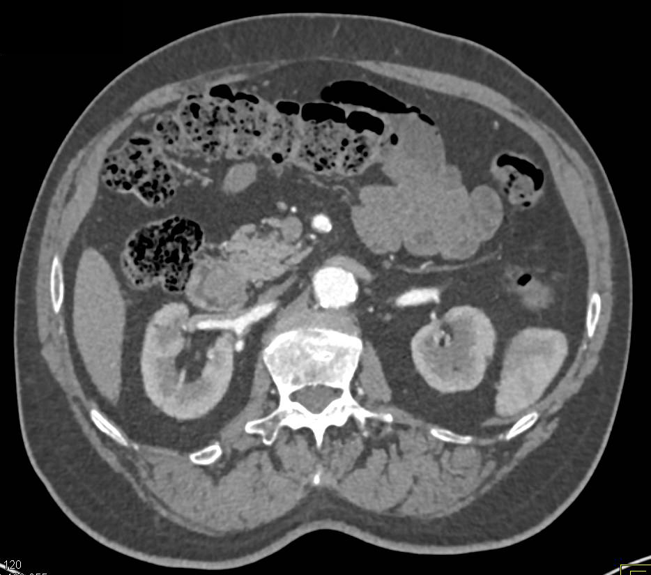 Ampullary Carcinoma Best Seen on Coronal 3D Views - CTisus CT Scan