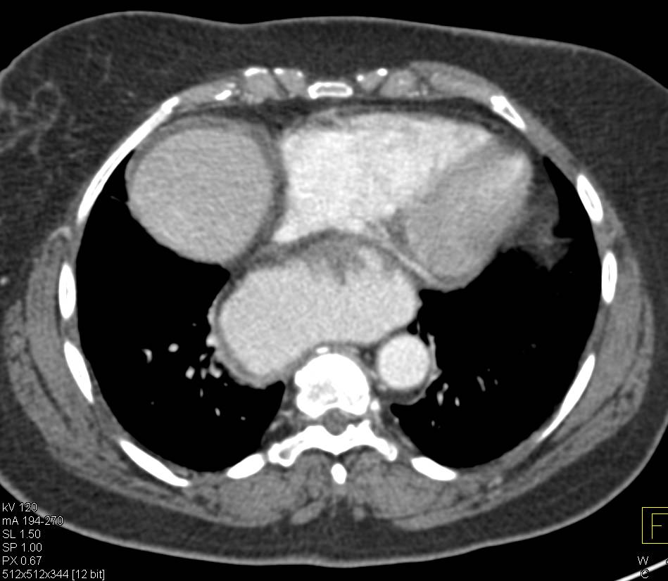 Crohn's Disease Terminal Ileum and Prominent Vasa Recta - CTisus CT Scan