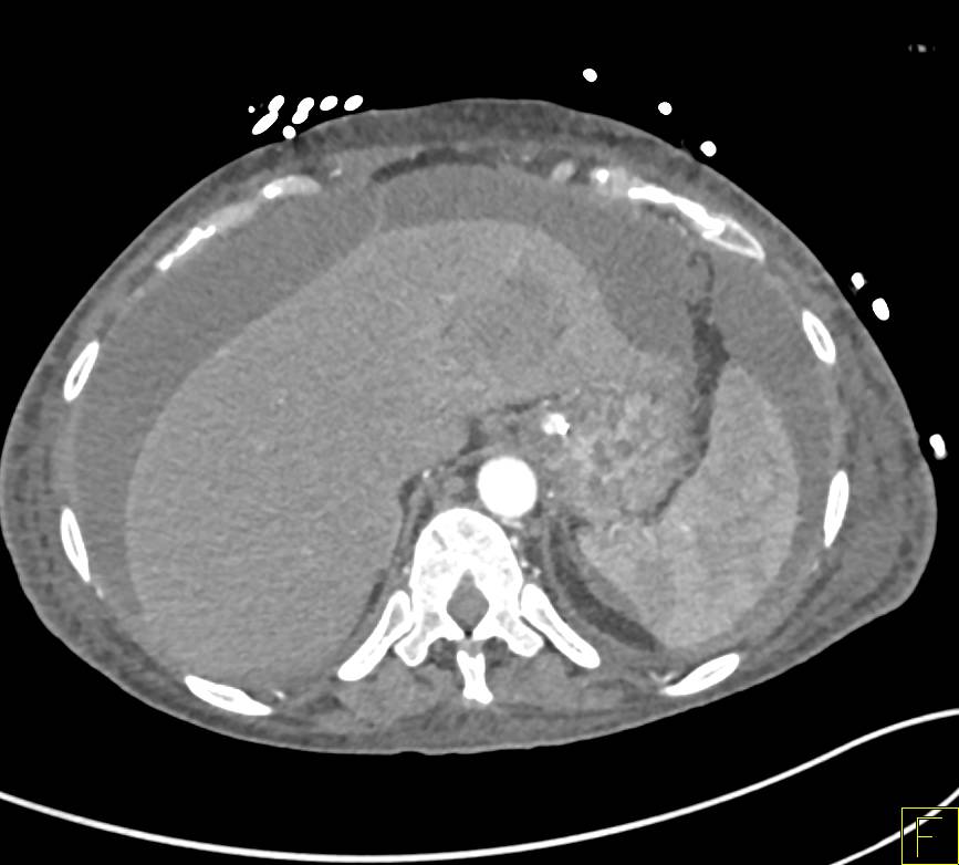 Sprue with Thickened Jejunal Folds - CTisus CT Scan