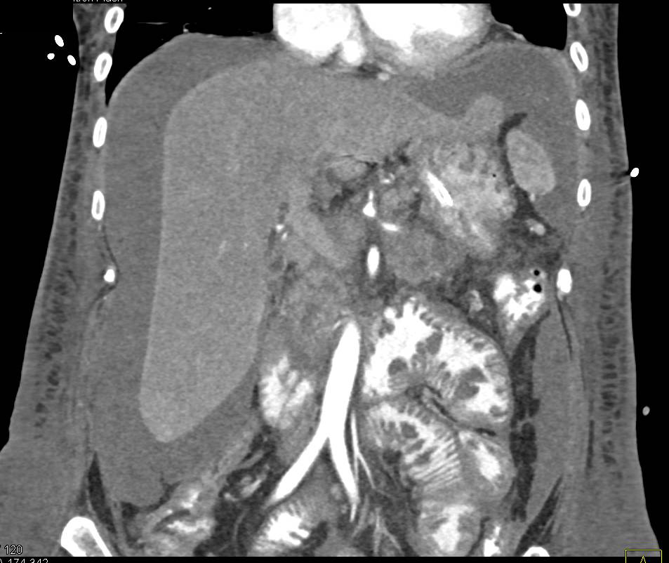 Pancreatic Cancer in Patient with Sprue with Ascites - CTisus CT Scan