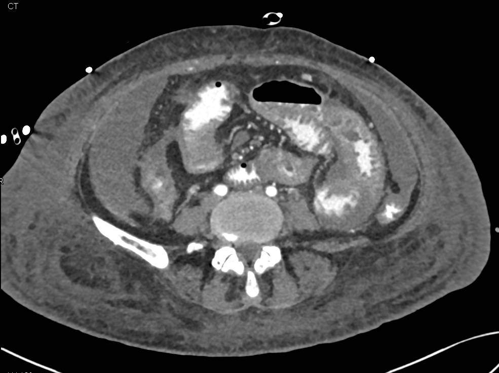 Sprue and Liver Abscss - CTisus CT Scan