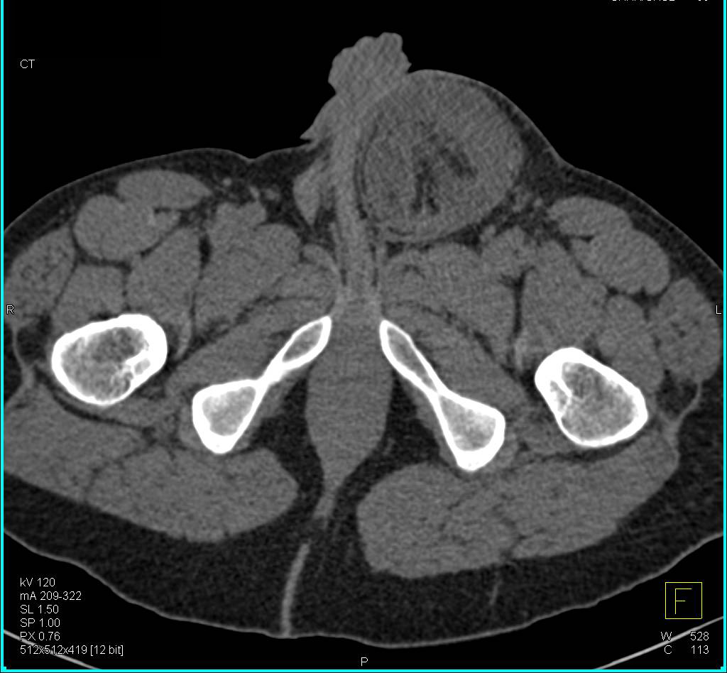 Large Inguinal Hernia with Incarcerated Bowel Into Scrotum - CTisus CT Scan