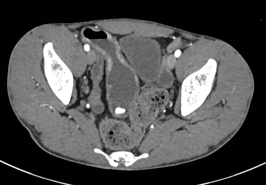 Crohn's Disease Ileum - CTisus CT Scan