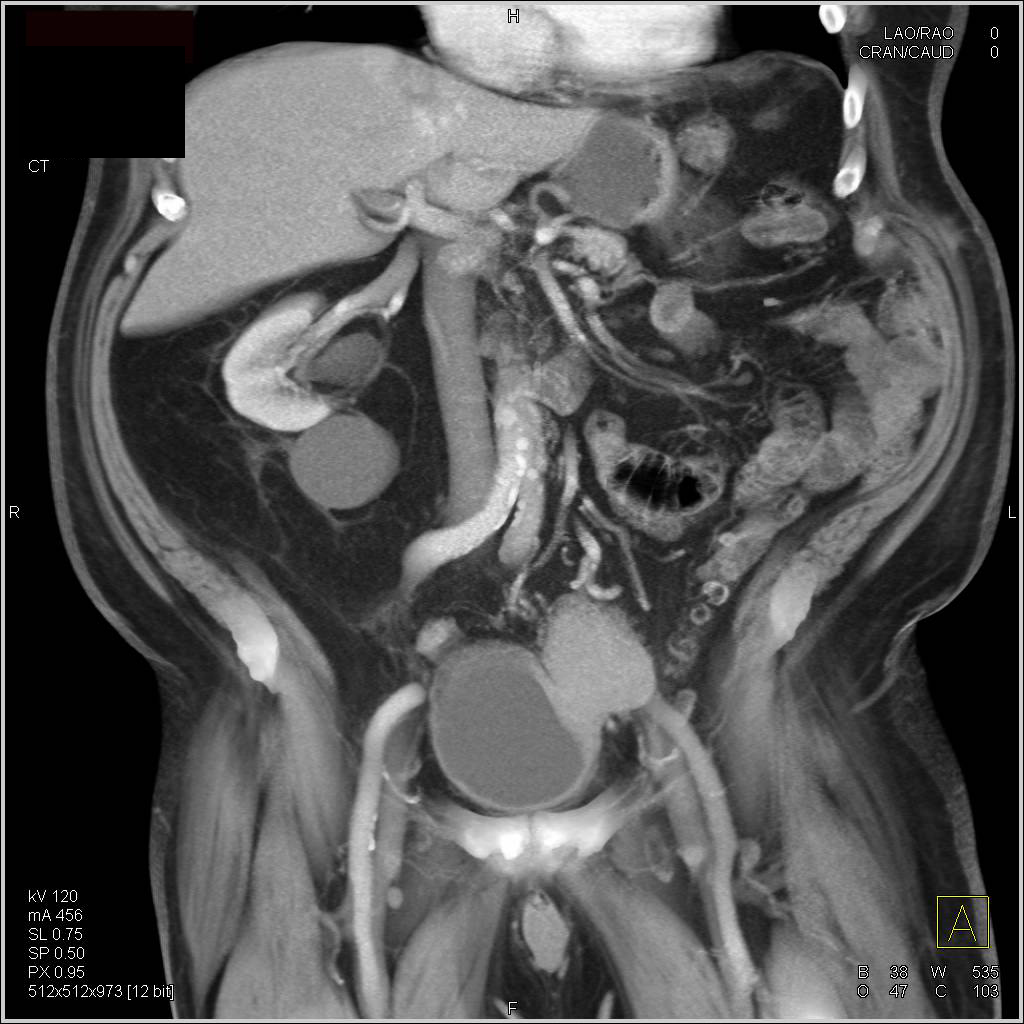 Small Bowel Adenocarcinoma at Transition Zone - CTisus CT Scan