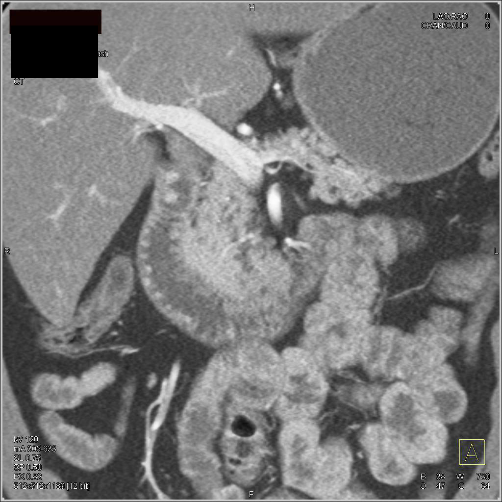 Multiple Vascular Neuroendocrine Tumors in the Duodenum - CTisus CT Scan