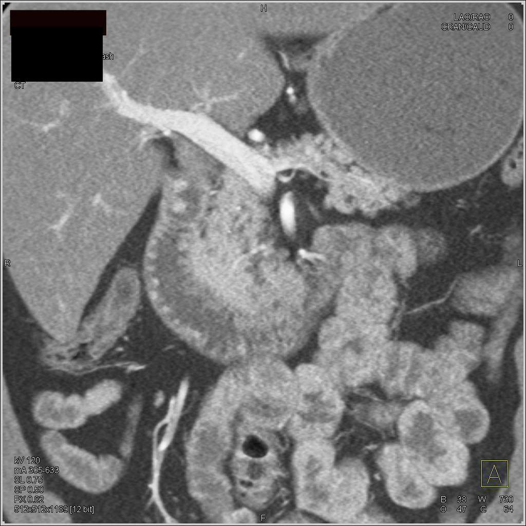 Neuroendocrine Tumor in Duodenum - Small Bowel Case Studies - CTisus CT ...