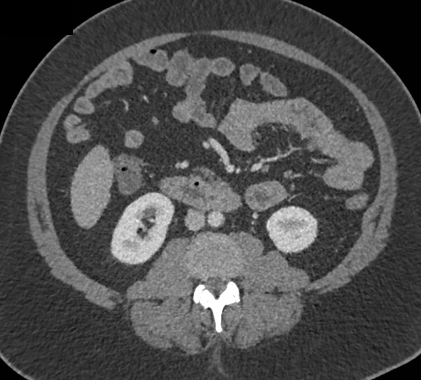 Adenocarcinoma Third Portion of the Duodenum - CTisus CT Scan