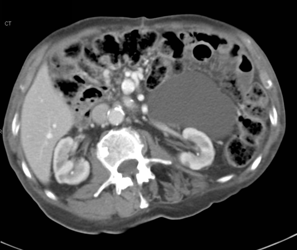 Mesenteric Cyst - CTisus CT Scan