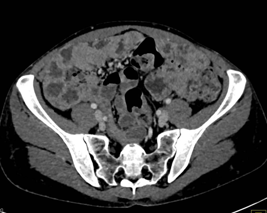 diffuse-thickening-of-small-bowel-small-bowel-case-studies-ctisus