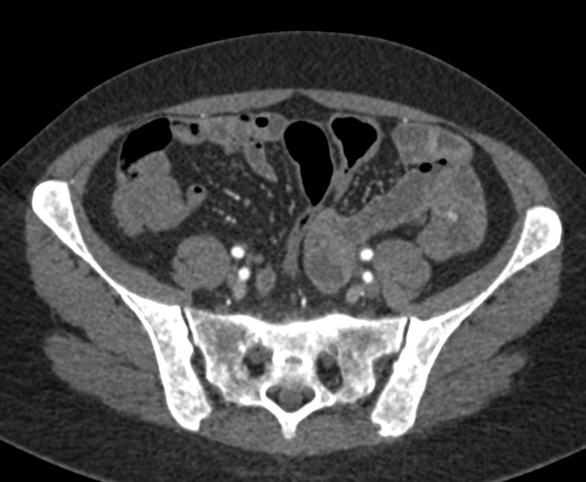 Small Vascular Lesion in Jejunum - CTisus CT Scan