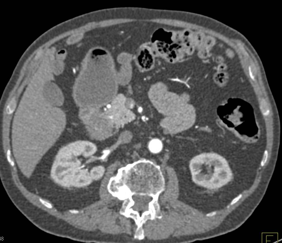 Carcinoma in First Portion of the Duodenum - CTisus CT Scan