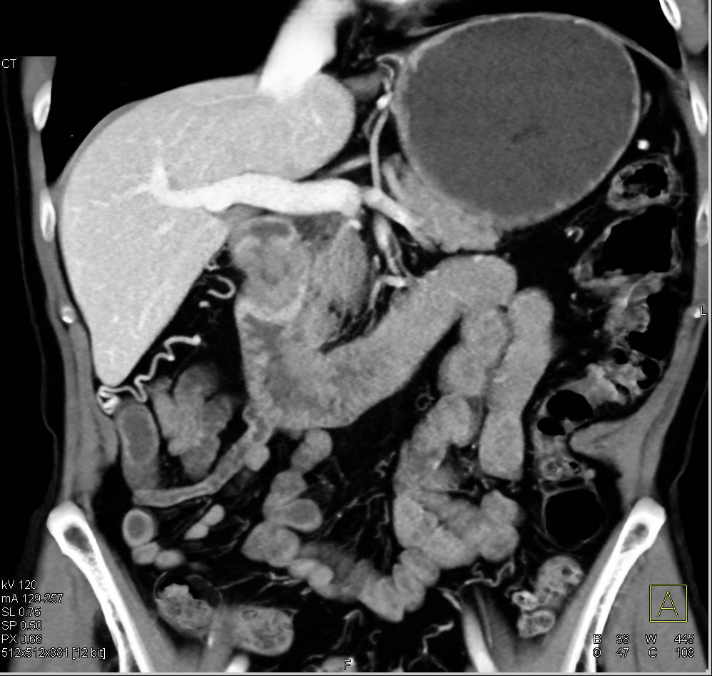 Carcinoma First Portion of Duodenum - CTisus CT Scan