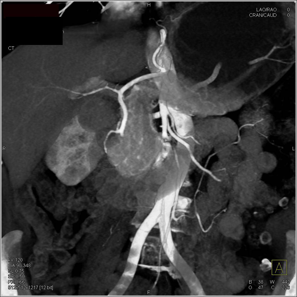 CTA and 3D Map of Duodenal Carcinoma - CTisus CT Scan