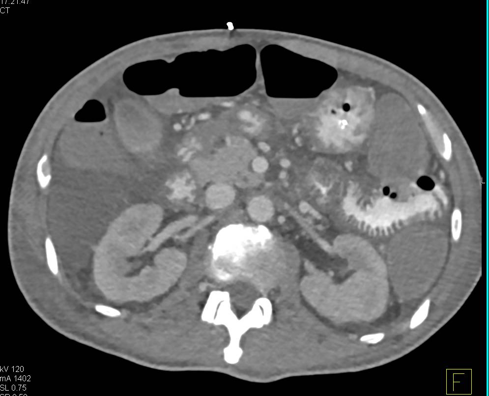 Edematous Small Bowel with Hypoproteinemia - CTisus CT Scan