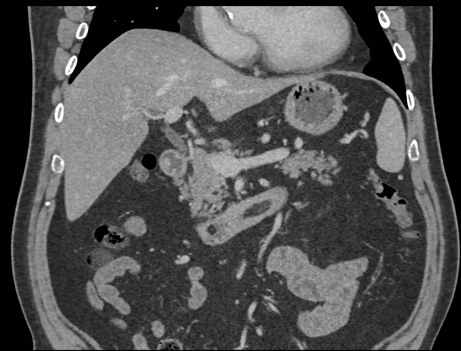 Incidental Duodenal Lipoma - CTisus CT Scan