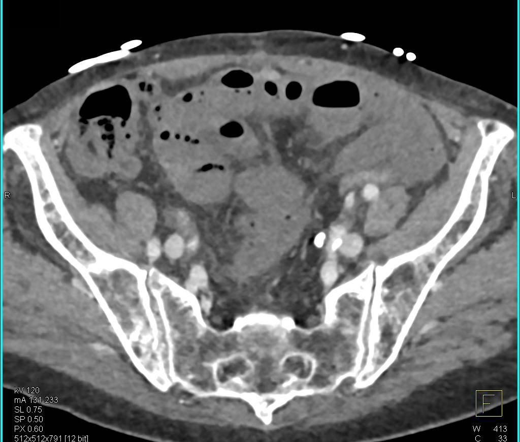 Superior Mesenteric Artery (SMA) Occlusion Best Seen on Sagittal View - CTisus CT Scan