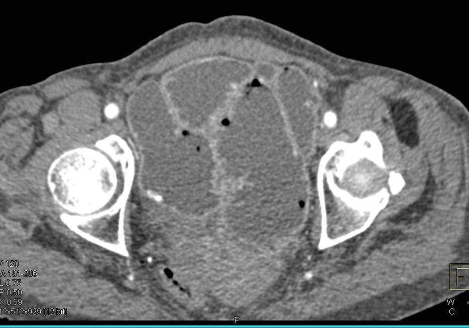 Small Bowel Obstruction due to Adhesions - CTisus CT Scan