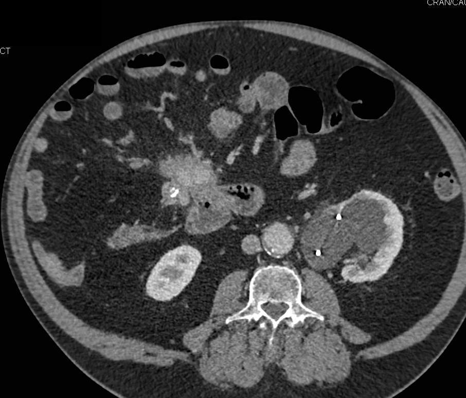 Carcinoid Tumor with Desmoplastic Reaction Simulates a Pancreatic ...